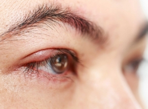 Cảnh báo: Những điều bạn phải biết về Dị ứng mắt do thời tiết